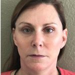 Face Lift Before & After Patient #1245