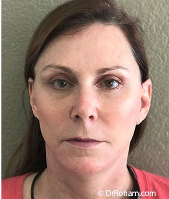 Patient #1245 Face Lift Before and After Photos Santa Ana - Plastic