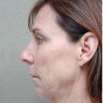 Face Lift Before & After Patient #1245
