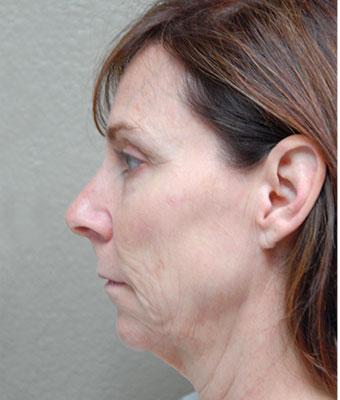 Face Lift Before & After Patient #1245