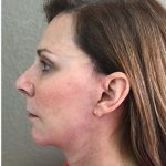 Face Lift Before & After Patient #1245