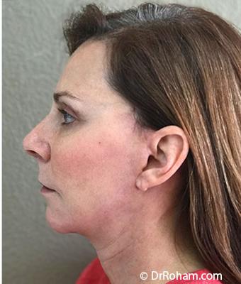 Face Lift Before & After Patient #1245