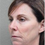 Face Lift Before & After Patient #1245