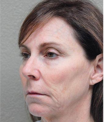 Face Lift Before & After Patient #1245