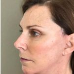 Face Lift Before & After Patient #1245
