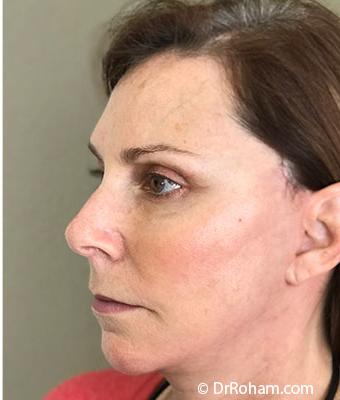 Face Lift Before & After Patient #1245