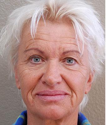 Face Lift Before & After Patient #1246