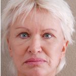 Face Lift Before & After Patient #1246