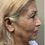 Face Lift Before & After Patient #1247