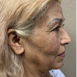 Face Lift Before & After Patient #1247