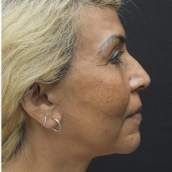 Face Lift Before & After Patient #1247