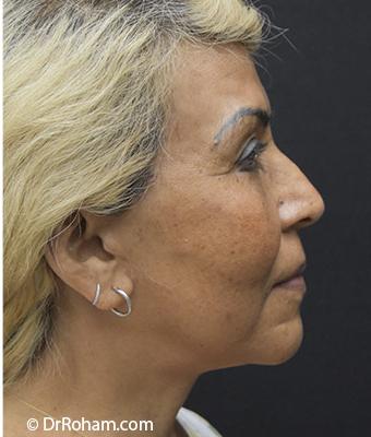 Face Lift Before & After Patient #1247