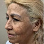 Face Lift Before & After Patient #1247