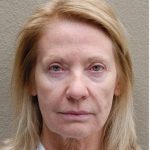 Face Lift Before & After Patient #1248