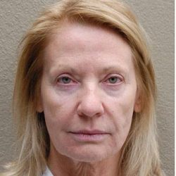 Face Lift Before & After Patient #1248