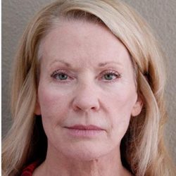 Face Lift Before & After Patient #1248