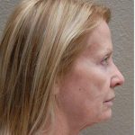 Face Lift Before & After Patient #1248