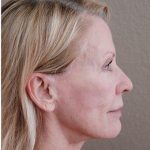 Face Lift Before & After Patient #1248