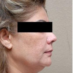 Face Lift Before & After Patient #1249