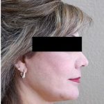 Face Lift Before & After Patient #1249