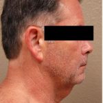 Face Lift Before & After Patient #1251