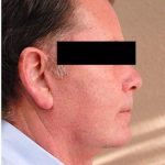 Face Lift Before & After Patient #1251