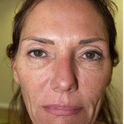 Face Lift Before & After Patient #1252