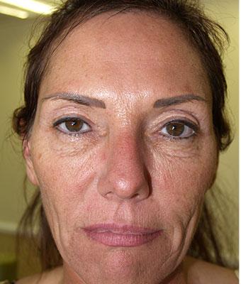 Face Lift Before & After Patient #1252