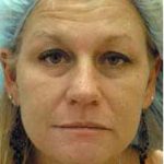Fat Transfer Face Before & After Patient #1391