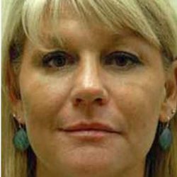 Fat Transfer Face Before & After Patient #1391