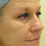 Fat Transfer Face Before & After Patient #1391
