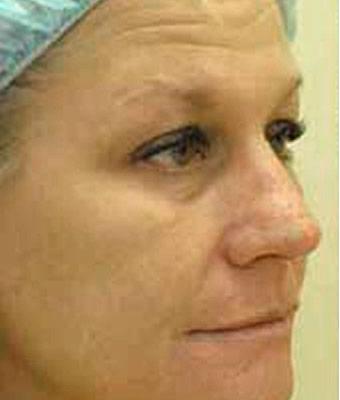 Fat Transfer Face Before & After Patient #1391