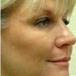 Fat Transfer Face Before & After Patient #1391