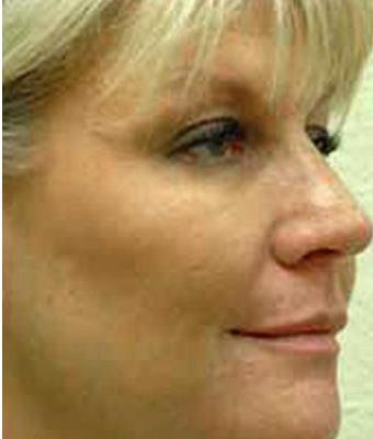 Fat Transfer Face Before & After Patient #1391
