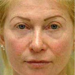 Fat Transfer Face Before & After Patient #1392