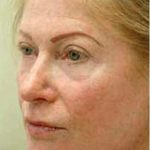 Fat Transfer Face Before & After Patient #1392