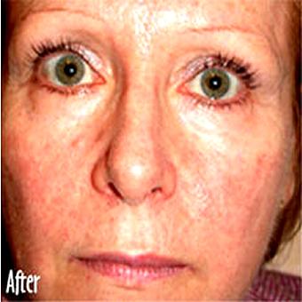 IPL Photo Facial Before & After Patient #1408