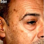IPL Photo Facial Before & After Patient #1409