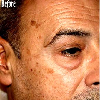 IPL Photo Facial Before & After Patient #1409