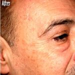 IPL Photo Facial Before & After Patient #1409