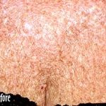 IPL Photo Facial Before & After Patient #1410