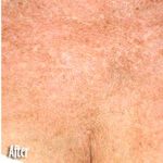 IPL Photo Facial Before & After Patient #1410
