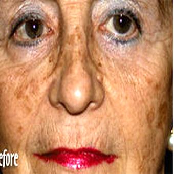 IPL Photo Facial Before & After Patient #1411