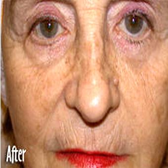 IPL Photo Facial Before & After Patient #1411