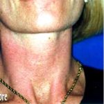 IPL Photo Facial Before & After Patient #1412