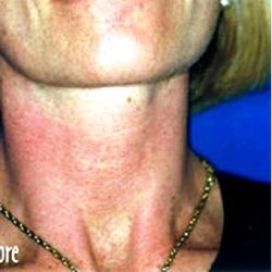 IPL Photo Facial Before & After Patient #1412
