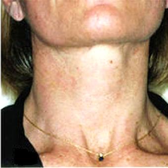 IPL Photo Facial Before & After Patient #1412