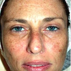 IPL Photo Facial Before & After Patient #1399