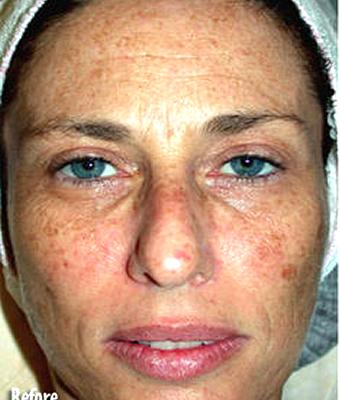 IPL Photo Facial Before & After Patient #1399