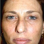 IPL Photo Facial Before & After Patient #1399